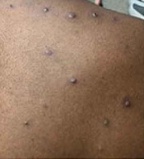 Monkeypox 5